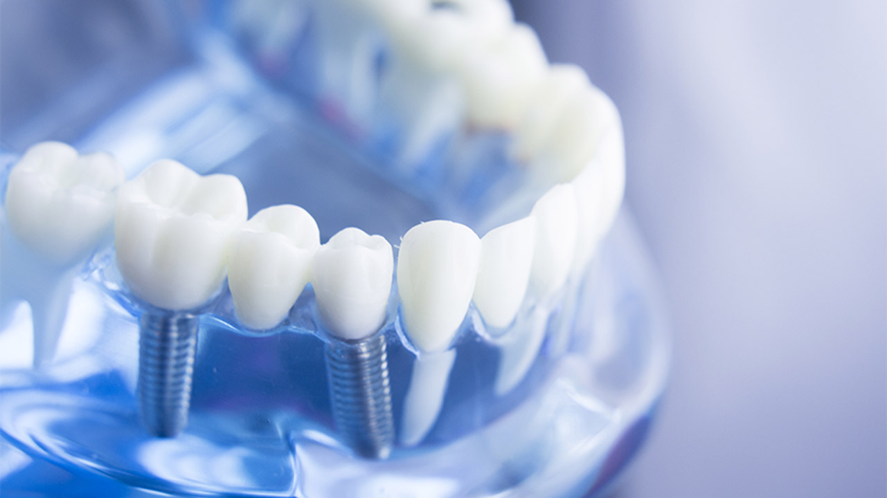 インプラント治療